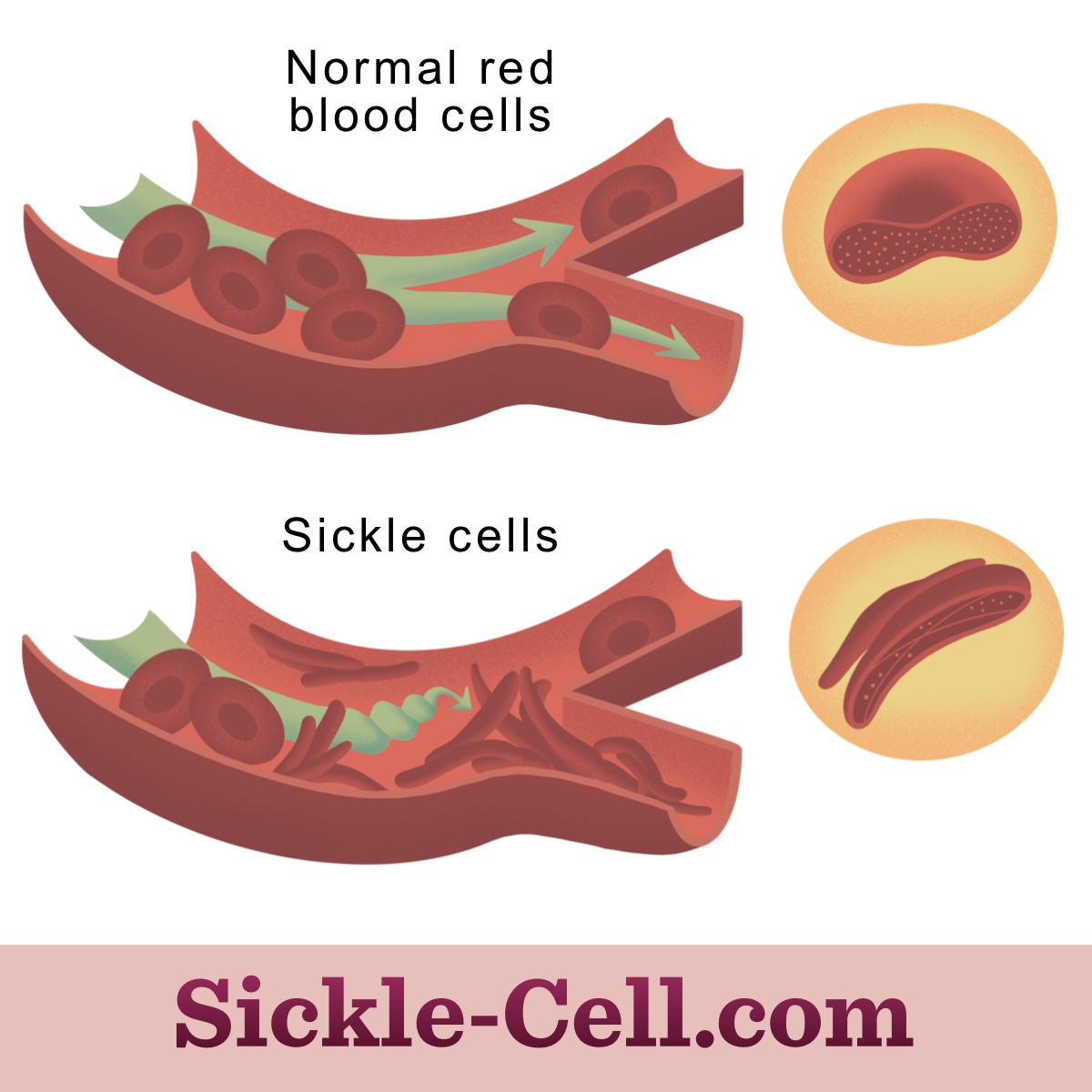 Sickle cells are crescent shaped due to rigid hemoglobin molecules. These sickle cells can cause blood vessels to be blocked.