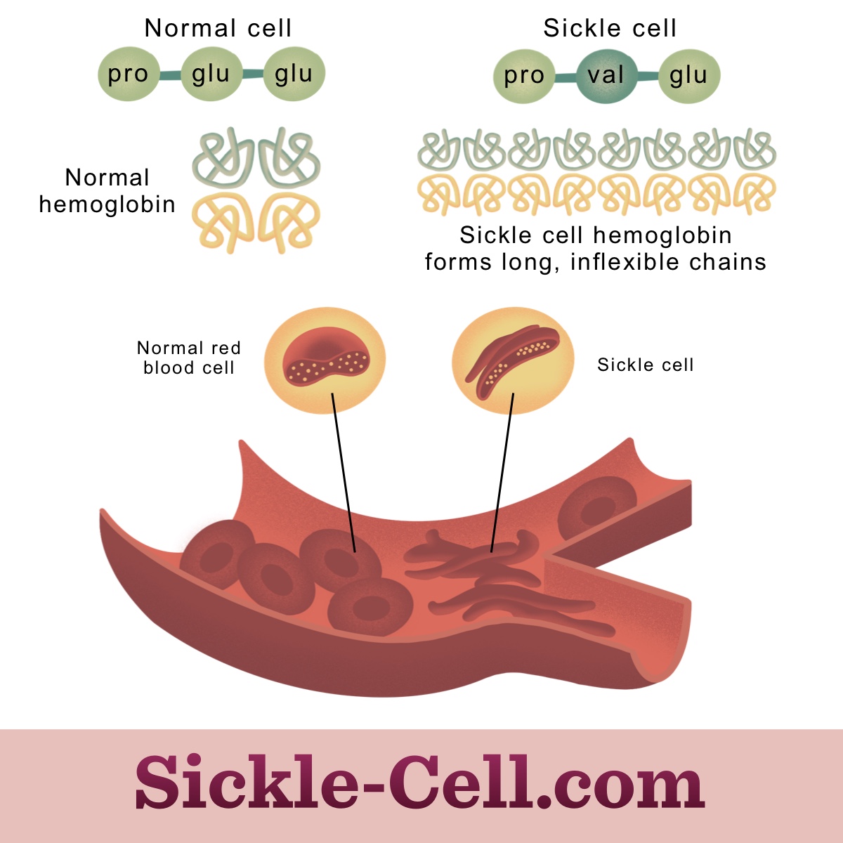 Compare normal and mutated sickle cell gene and subsequent phenotypes (gene expression) of hemoglobin in red blood cells.