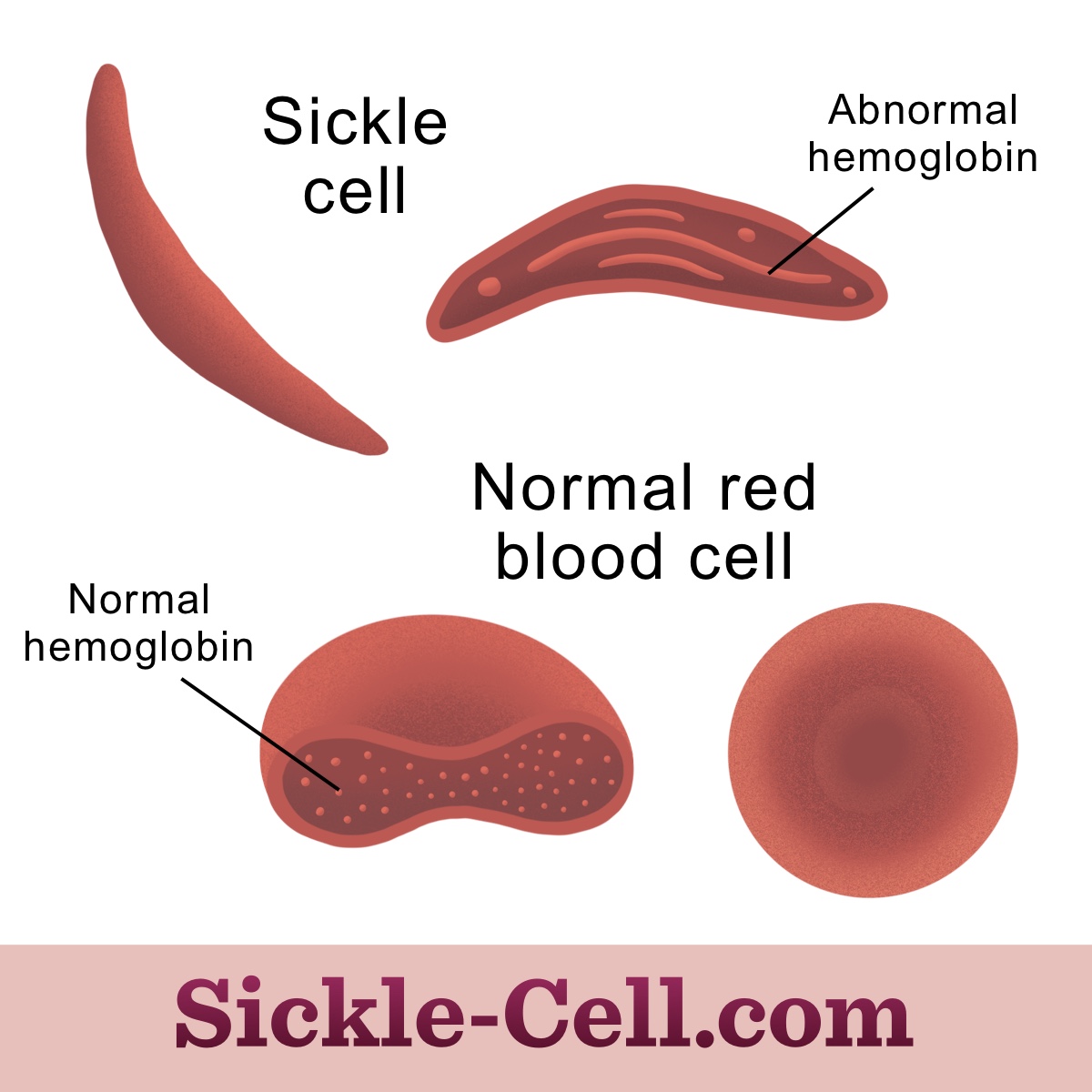 What is the difference between sickle cells and healthy RBCs?