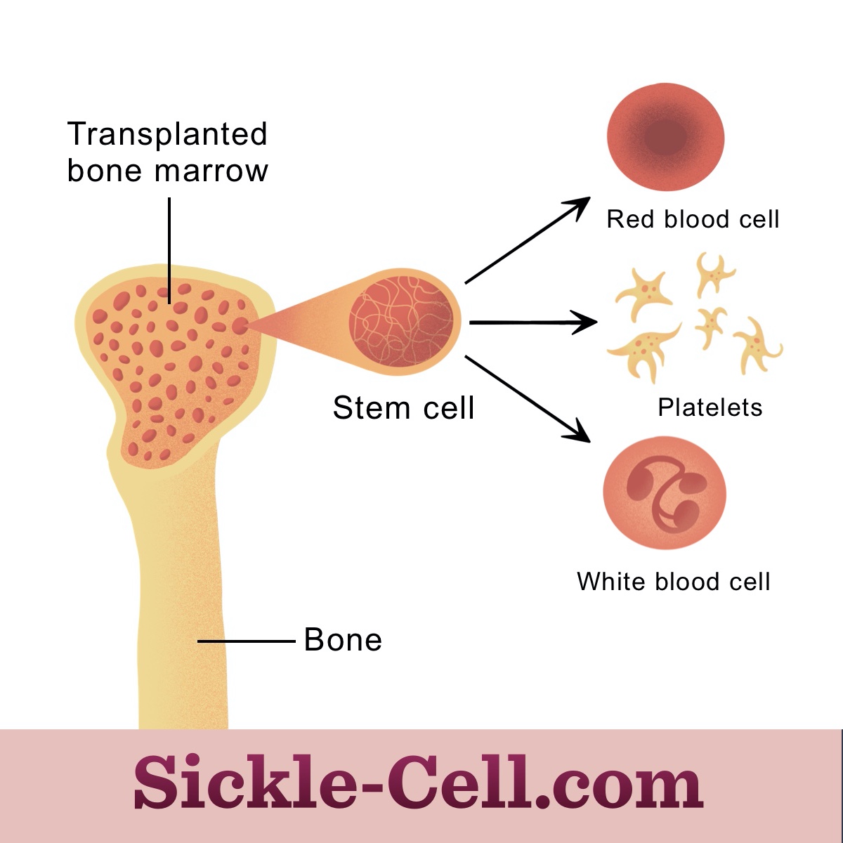 Bone marrow transfusions provide the body with unmutated stem cells. This allows for the generation of healthy blood cells.