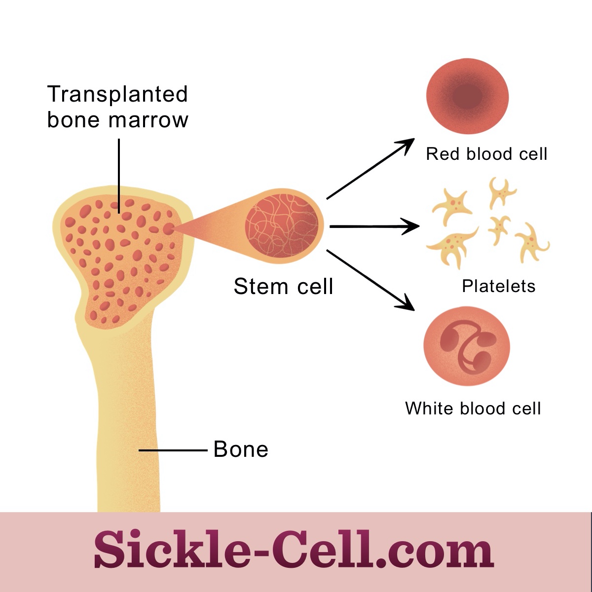 allogeneic bone marrow transplant